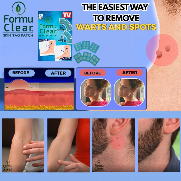 Manchas para remover verrugas sem dor
